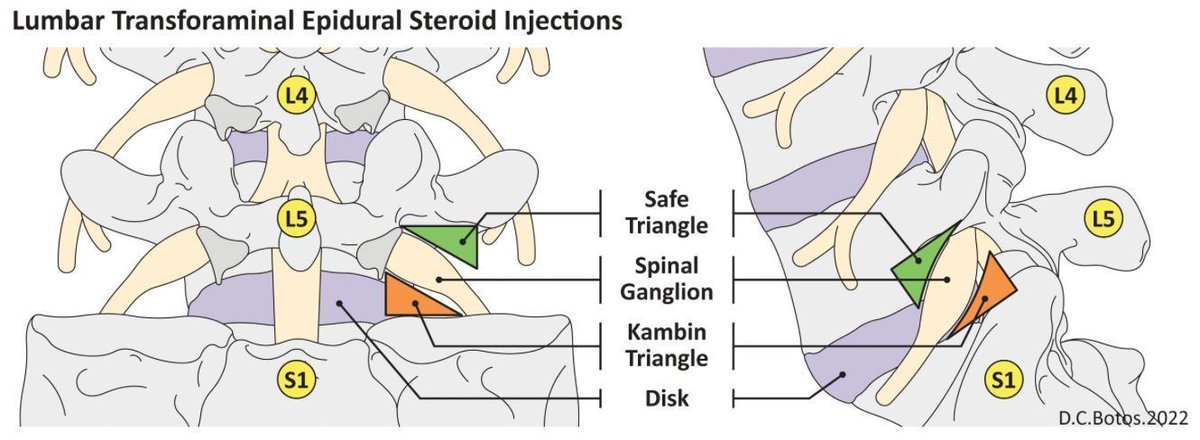 Anesthesia&Analgesia (@iars_journals) on Twitter photo #ProCon Debate: Superiors vs. Inferior Needle Placement for #transforaminal #epidural #steroid injections?
buff.ly/3QMpQXC
#PainMedicine <a href="/dr_tinadoshi/">Tina Doshi</a> <a href="/alysonengle/">Alyson Engle</a> <a href="/ANels_MD/">Ariana M. Nelson, MD</a> #ProCon Debate: Superiors vs. Inferior Needle Placement for #transforaminal #epidural #steroid injections?
buff.ly/3QMpQXC
#PainMedicine <a href="/dr_tinadoshi/">Tina Doshi</a> <a href="/alysonengle/">Alyson Engle</a> <a href="/ANels_MD/">Ariana M. Nelson, MD</a>