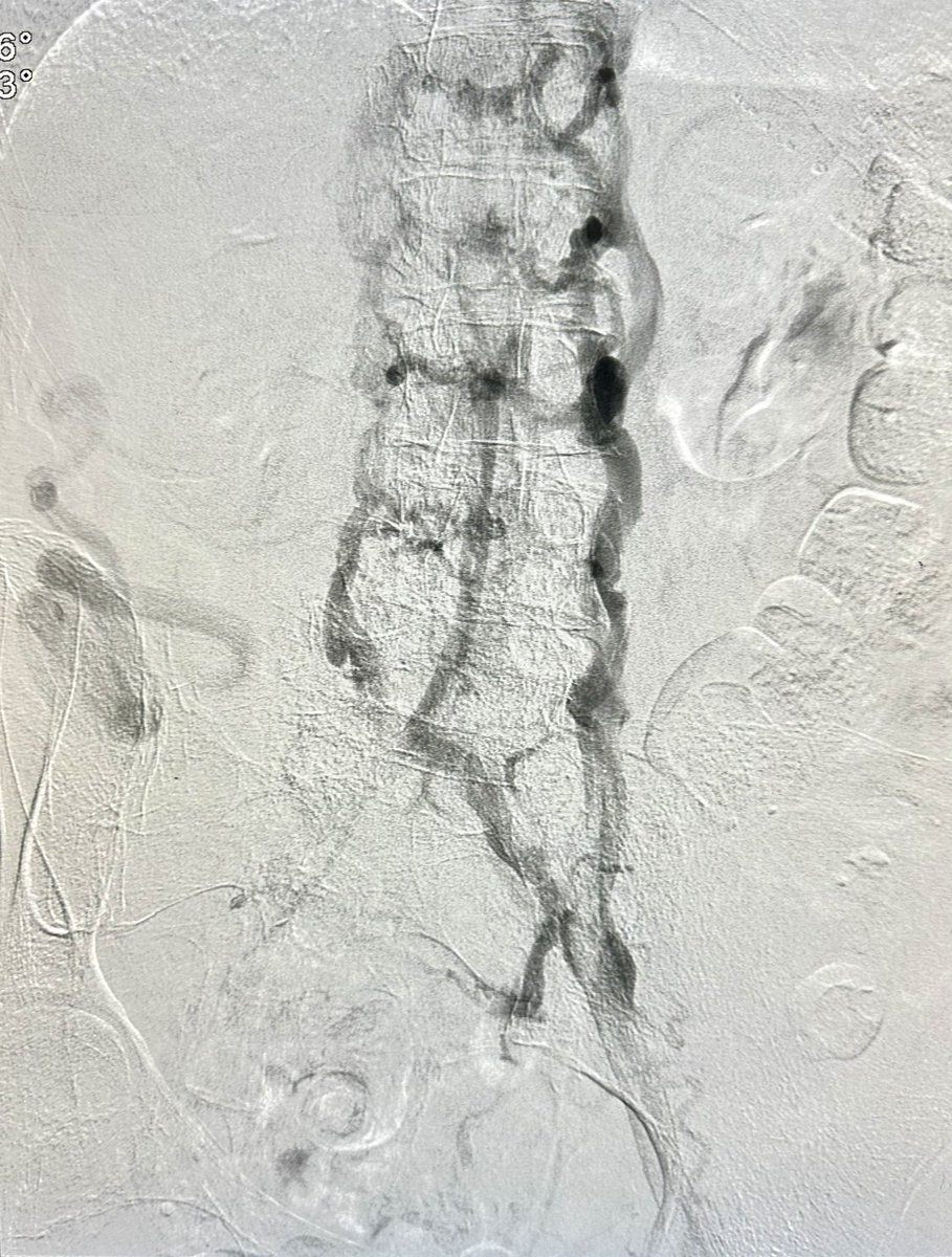 dr_ashishg's tweet image. Pt with h/o LLE DVT rxed with surgical thrombectomy remotely, with B/L LE edema and ulcers. Had CTO of infrarenal IVC and bilateral iliac veins, treated with IVUS venoplasty, double barrel stenting of IVC to bilateral EIV and RCFV @OEISociety @VenousForum @VIVAPhysicians