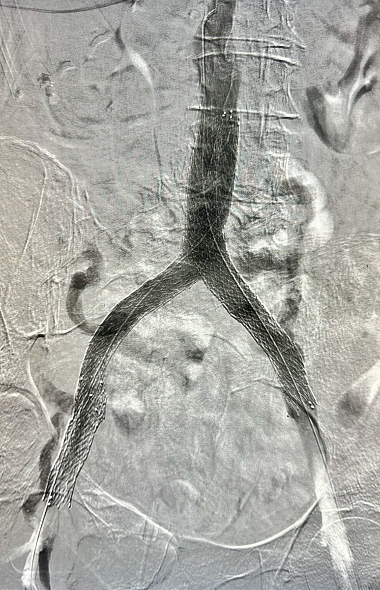 Ashish Gupta, MD, PhD (@dr_ashishg) on Twitter photo Pt with h/o LLE DVT rxed with surgical thrombectomy remotely, with B/L LE edema and ulcers. Had CTO of infrarenal IVC and bilateral iliac veins, treated with IVUS venoplasty, double barrel stenting of IVC to bilateral EIV and RCFV <a href="/OEISociety/">OEIS Society</a> <a href="/VenousForum/">American Venous Forum | AVF</a> <a href="/VIVAPhysicians/">The VIVA Foundation</a> Pt with h/o LLE DVT rxed with surgical thrombectomy remotely, with B/L LE edema and ulcers. Had CTO of infrarenal IVC and bilateral iliac veins, treated with IVUS venoplasty, double barrel stenting of IVC to bilateral EIV and RCFV <a href="/OEISociety/">OEIS Society</a> <a href="/VenousForum/">American Venous Forum | AVF</a> <a href="/VIVAPhysicians/">The VIVA Foundation</a>