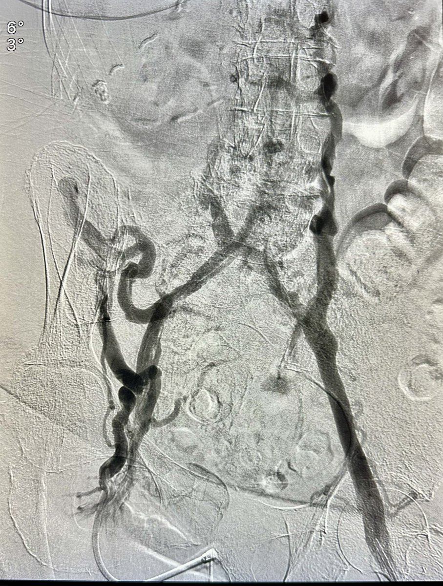 dr_ashishg's tweet image. Pt with h/o LLE DVT rxed with surgical thrombectomy remotely, with B/L LE edema and ulcers. Had CTO of infrarenal IVC and bilateral iliac veins, treated with IVUS venoplasty, double barrel stenting of IVC to bilateral EIV and RCFV @OEISociety @VenousForum @VIVAPhysicians