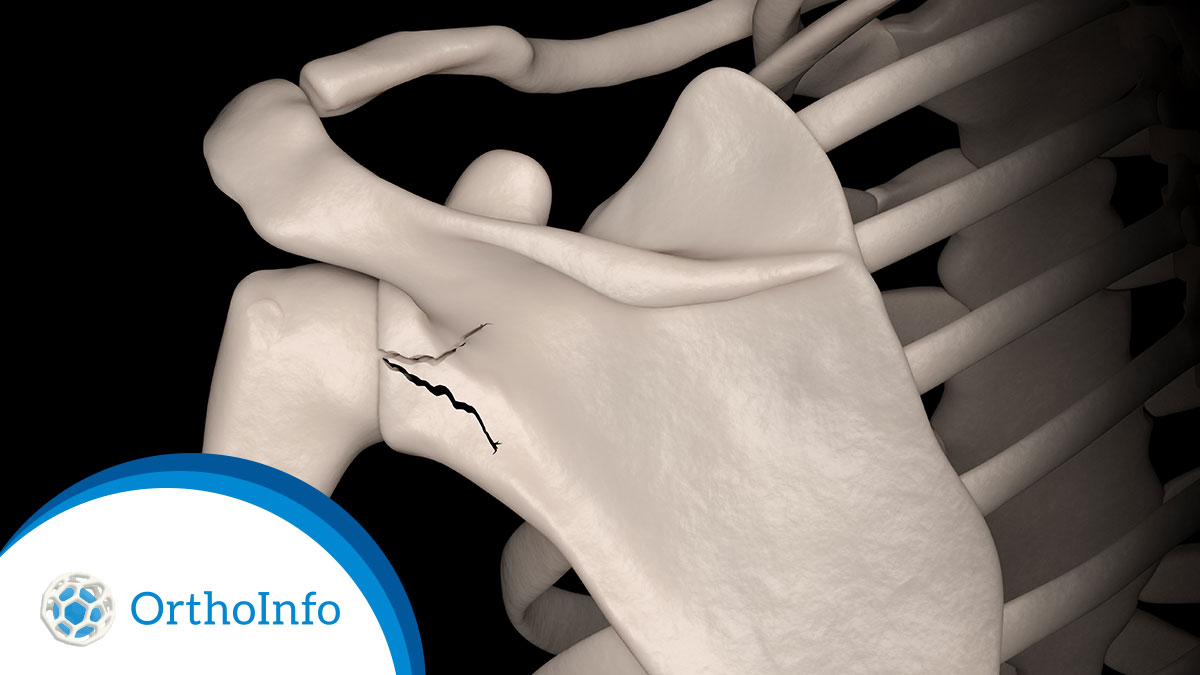 AAOS1's tweet photo. Desean Watson will miss the rest of the 2023 @NFL season with a #glenoidfracture. Fractures of the glenoid &amp; other parts of the #shoulderblade are rare. Learn how they occur &amp; are diagnosed at #OrthoInfo: https://t.co/kaExVu8Fd4 @Browns @ASESmembers @otatrauma #Orthotwitter https://t.co/YQpjRbpoIk