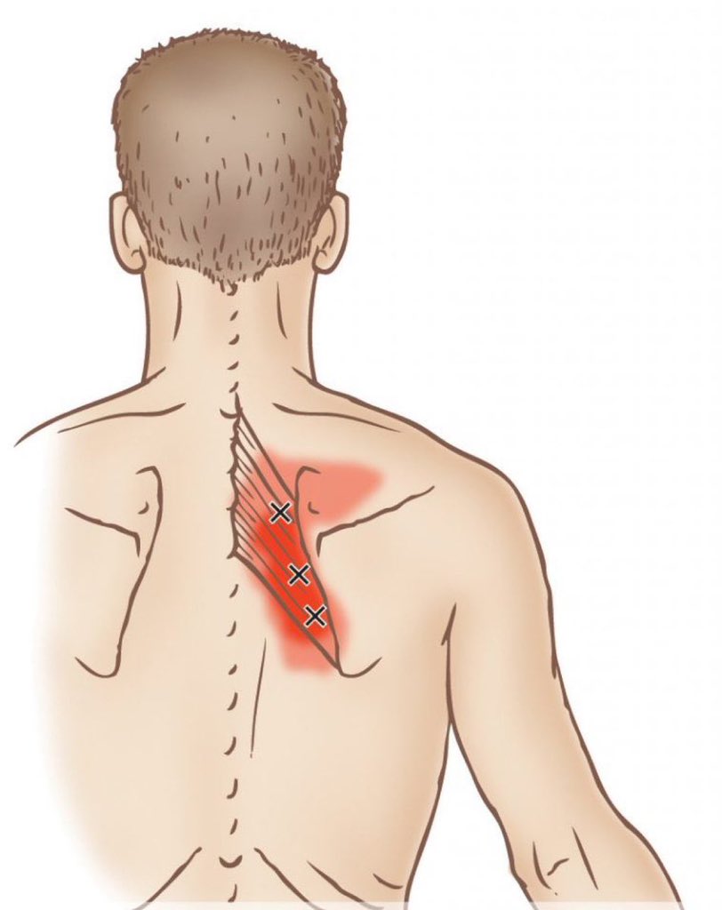 عندك ألم بهذا المكان ؟ 
الكثير يعانون من الأم الابهر !!
في هذا الثريد ساتحدث عن ( الابهر ) وماهي مسبباته مع حلوله و علاجة بالتفصيل ..

لو مشغول فضلها بتفيدك وارجع لها بعدين ❤️‍🩹