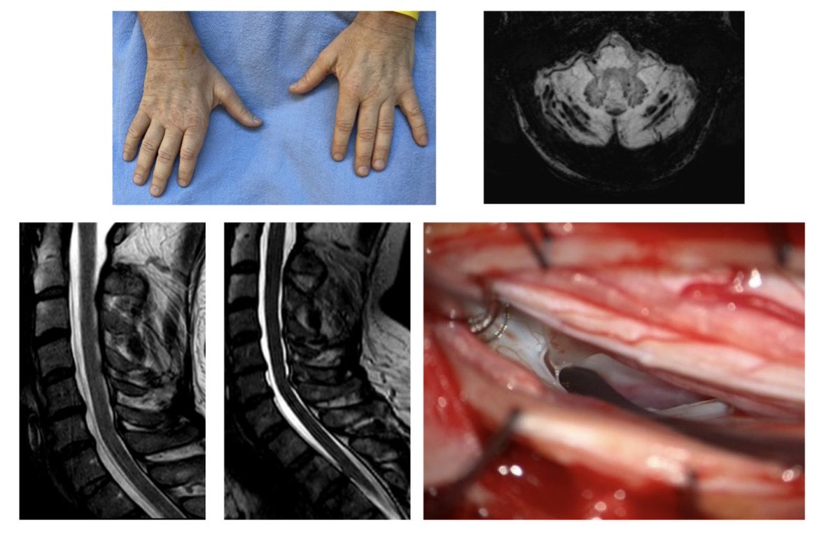 Bibrachial amyotrophy, superficial siderosis, and spinal cord herniation are three long-term sequelae of a ventral spinal CSF leak. This is the first patient we’ve ever seen who had all three. The cord herniation slowed down the leak ⁦@spinalCSFleak⁩ ⁦@LivingwithSS⁩