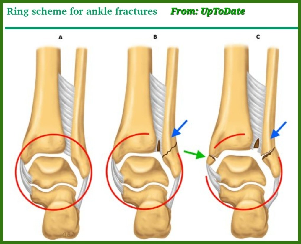 Ankle can be conceived of a ring of supporting structures,around talus (A). If ring broken at one site (B),injury is stable managed nonoperatively. If ring is broken at 2 or more sites(C), injury is unstable managed operatively. Fx or lig ruptures constitute breaks in the ring