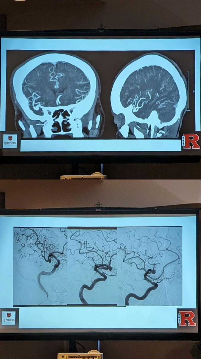 SVIN (@svinsociety) on Twitter photo ‼️ SVINightmares Summit Case 4 by <a href="/dockhandelwal/">priyank khandelwal</a> on MCA aneurysm treatment with PED.
<a href="/SVINJournal/">Stroke: Vascular and Interventional Neurology</a> <a href="/MThrombectomy/">Mission Thrombectomy</a> <a href="/WomenInNeuroIR/">WINN 🇺🇦</a> <a href="/YoungNIR/">YoungNIR</a> <a href="/ESOstroke/">European Stroke Org</a>
<a href="/almuftifawaz/">Fawaz Al-Mufti, MD, FSVIN</a> <a href="/elghanemmoh/">Mohammad El-Ghanem</a> <a href="/DanielVelaMD/">Daniel Vela-Duarte, MD</a> <a href="/rwregen/">Robert Regenhardt, MD, PhD</a> <a href="/NuroseKarim/">Nurose Karim</a> <a href="/SitaraKoneru/">Sitara Koneru, MD</a> <a href="/gdawod1/">Giana Dawod, MD</a> ‼️ SVINightmares Summit Case 4 by <a href="/dockhandelwal/">priyank khandelwal</a> on MCA aneurysm treatment with PED.
<a href="/SVINJournal/">Stroke: Vascular and Interventional Neurology</a> <a href="/MThrombectomy/">Mission Thrombectomy</a> <a href="/WomenInNeuroIR/">WINN 🇺🇦</a> <a href="/YoungNIR/">YoungNIR</a> <a href="/ESOstroke/">European Stroke Org</a>
<a href="/almuftifawaz/">Fawaz Al-Mufti, MD, FSVIN</a> <a href="/elghanemmoh/">Mohammad El-Ghanem</a> <a href="/DanielVelaMD/">Daniel Vela-Duarte, MD</a> <a href="/rwregen/">Robert Regenhardt, MD, PhD</a> <a href="/NuroseKarim/">Nurose Karim</a> <a href="/SitaraKoneru/">Sitara Koneru, MD</a> <a href="/gdawod1/">Giana Dawod, MD</a>