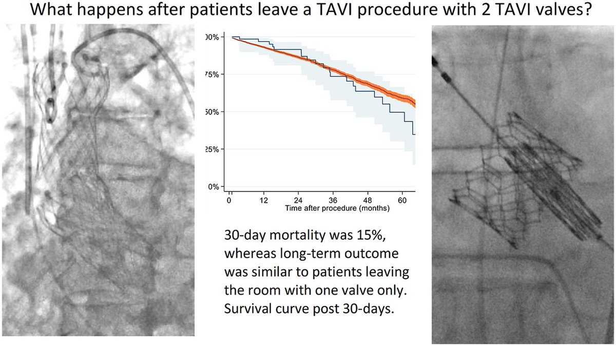Troels Yndigegn (@yndigegny) on Twitter photo Recently published within the SWENTRY/<a href="/RealSwedeheart/">Swedeheart</a> Framework: Outcomes of Patients Receiving a Second Rescue Valve During Transcatheter Aortic Valve Implantation.
doi.org/10.1016/j.shj.… Recently published within the SWENTRY/<a href="/RealSwedeheart/">Swedeheart</a> Framework: Outcomes of Patients Receiving a Second Rescue Valve During Transcatheter Aortic Valve Implantation.
doi.org/10.1016/j.shj.…