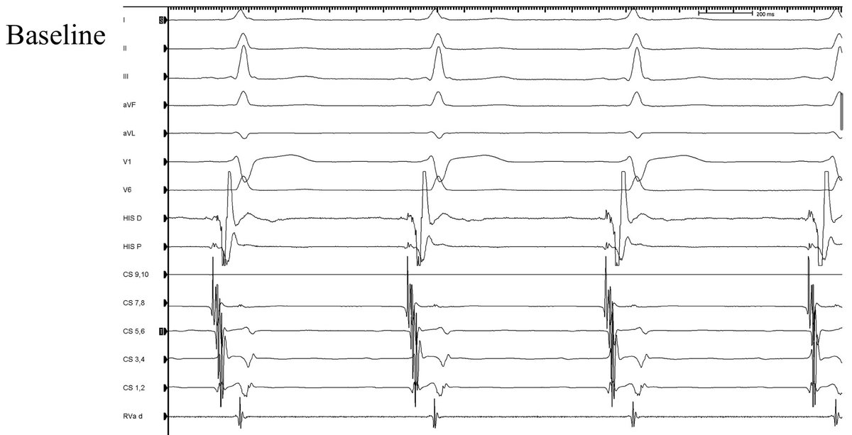 FellowEP's tweet image. Not every accessory pathway requires ablation!!!. Received a referral for a 21y 👱‍♂️with preexcitation on ECG and palpitations (no documented SVT). Any Thoughts?  #wpw #EPeeps @ALFIEEP1 @victorneirav @pabsala @SergioPinski @narrowQRS @LAHRSonline1