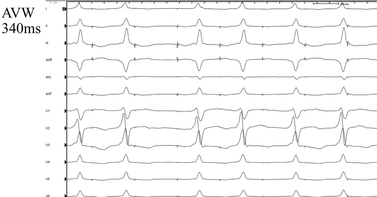 FellowEP's tweet image. Not every accessory pathway requires ablation!!!. Received a referral for a 21y 👱‍♂️with preexcitation on ECG and palpitations (no documented SVT). Any Thoughts?  #wpw #EPeeps @ALFIEEP1 @victorneirav @pabsala @SergioPinski @narrowQRS @LAHRSonline1