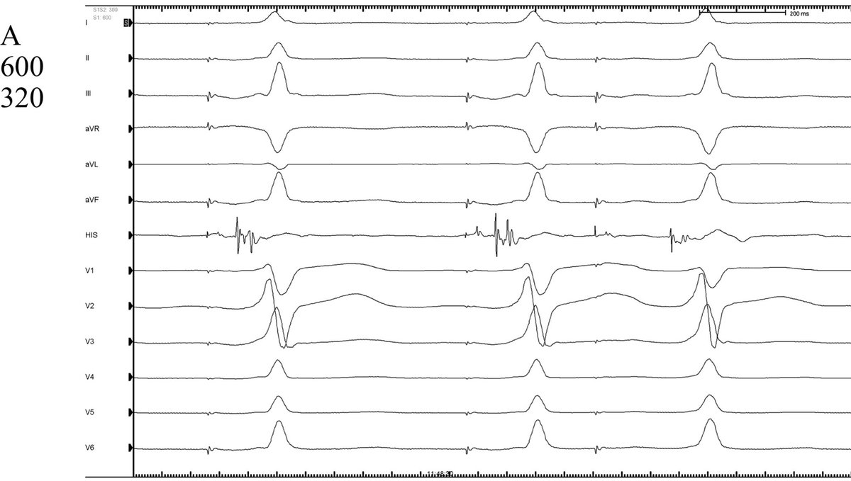 FellowEP's tweet image. Not every accessory pathway requires ablation!!!. Received a referral for a 21y 👱‍♂️with preexcitation on ECG and palpitations (no documented SVT). Any Thoughts?  #wpw #EPeeps @ALFIEEP1 @victorneirav @pabsala @SergioPinski @narrowQRS @LAHRSonline1