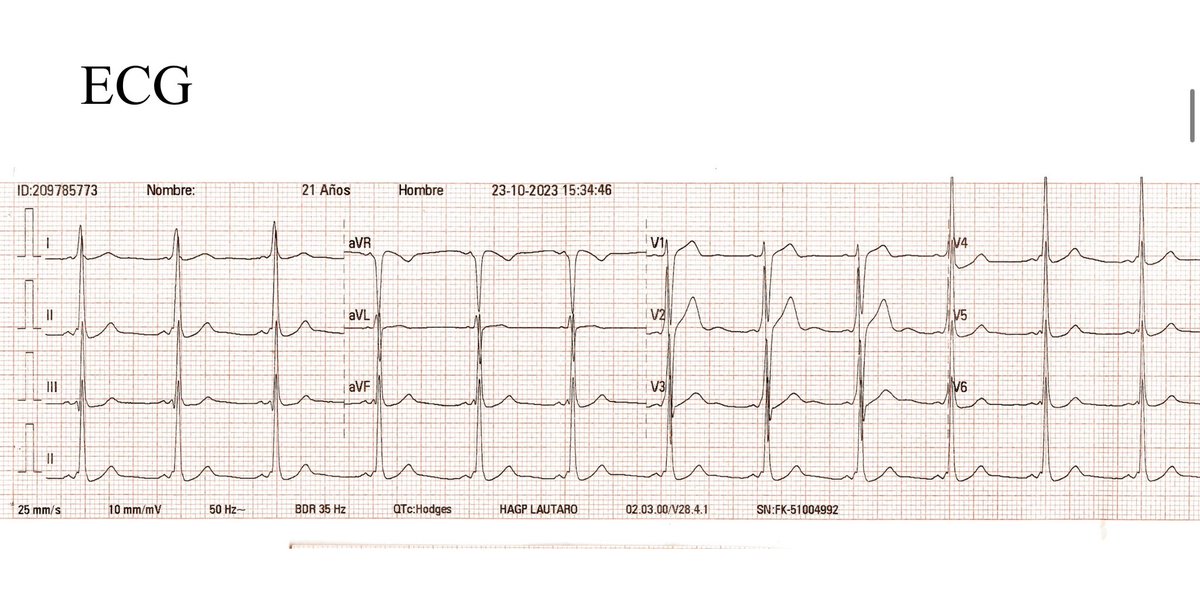 FellowEP's tweet image. Not every accessory pathway requires ablation!!!. Received a referral for a 21y 👱‍♂️with preexcitation on ECG and palpitations (no documented SVT). Any Thoughts?  #wpw #EPeeps @ALFIEEP1 @victorneirav @pabsala @SergioPinski @narrowQRS @LAHRSonline1
