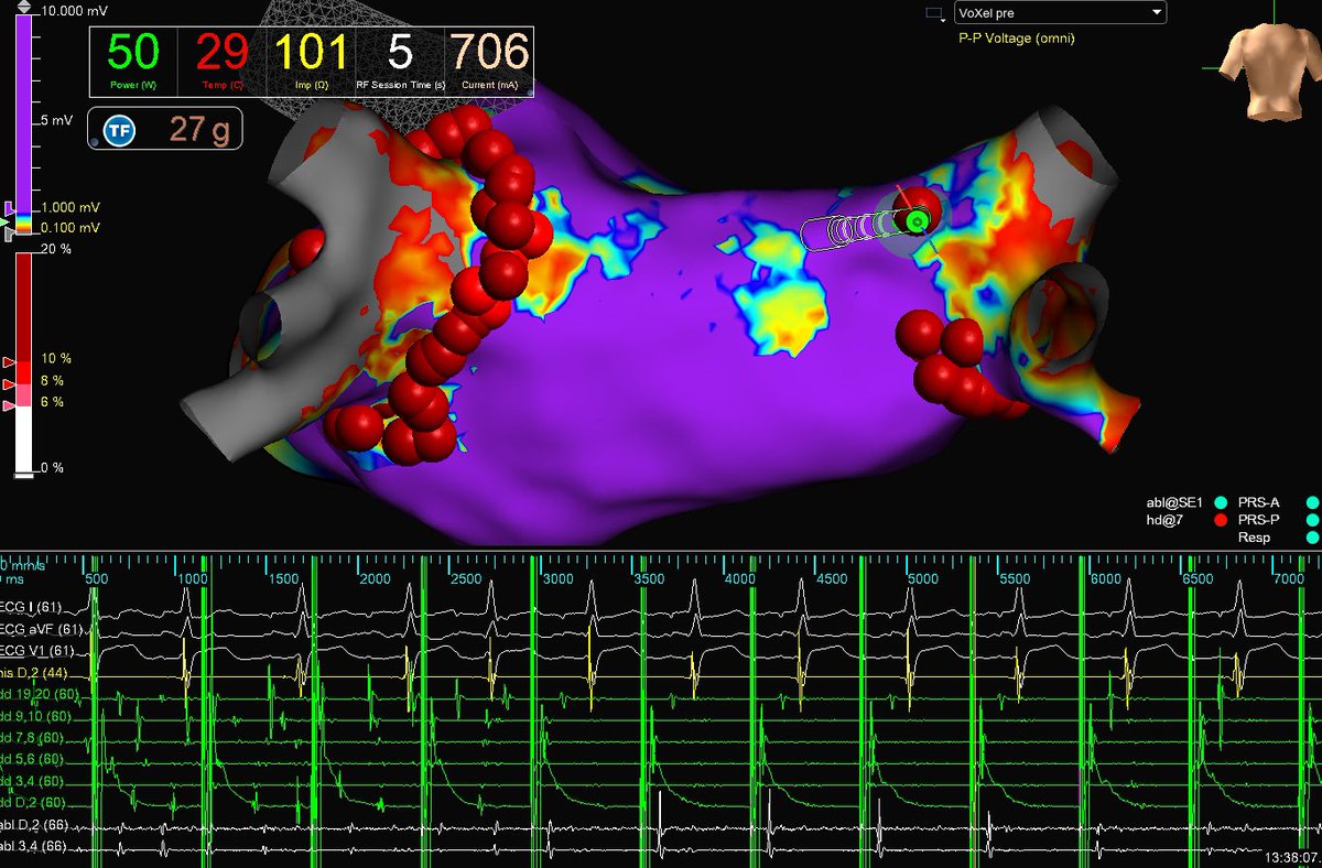 theRhythmDocs's tweet photo. Satisfying end to the week seeing rhythm convert from AF during ablation with #TactiFlex. Note attenuation of abl EGMs during RF session that broke to sinus. 

EP: Dr. Sameer Satija 
Map: @_JeanStein @meghapandyaep https://t.co/pHPxyE8xuL
