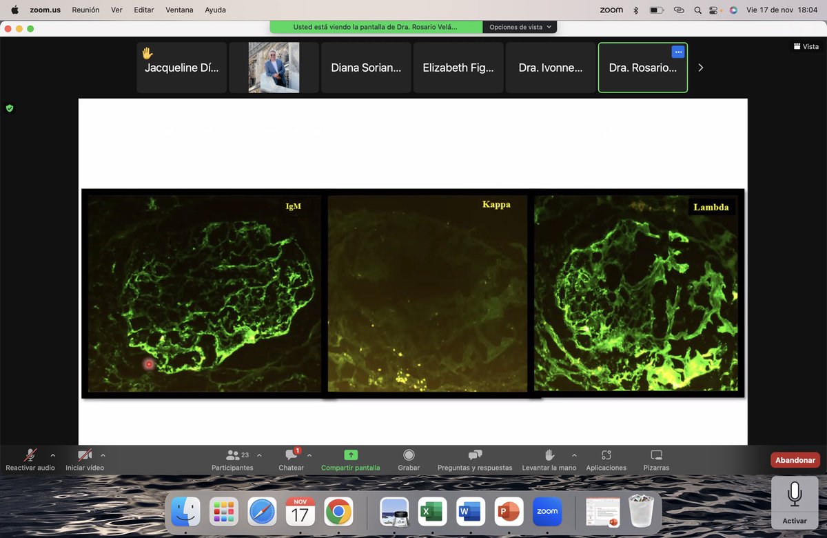 rafavaldeznefro's tweet image. Hoy se presentó la última sesión interinstitucional de nefropatología de este año. 

Con un caso muy interesante de gamapatía monoclonal con significado renal. 

Felicidades a las doctoras @IvonneV7 y Rosario Velázquez por la presentación del caso. @hgm_nefrologia 

#somosimin