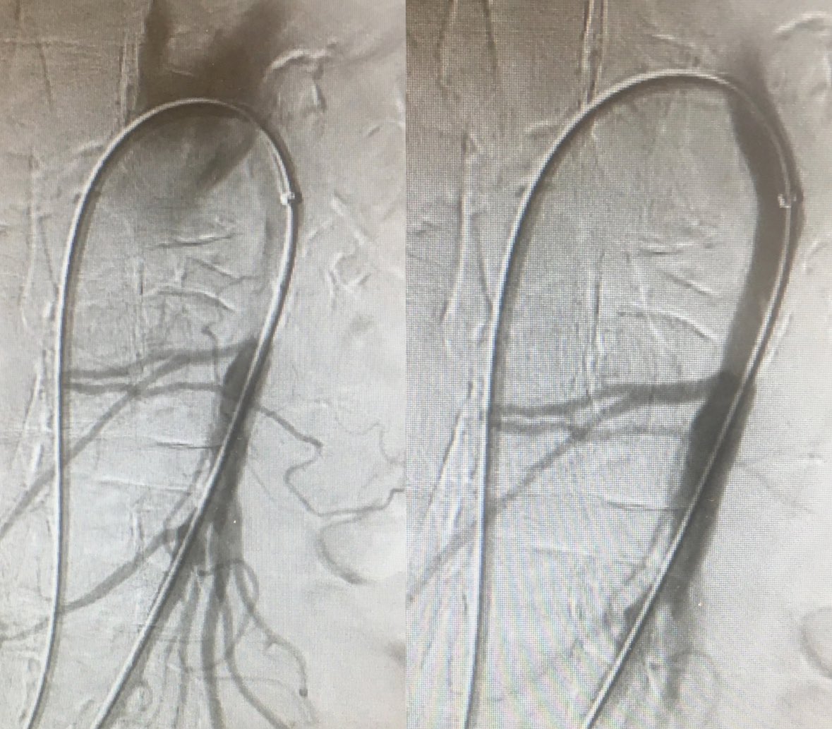 Thats an example of insitu thrombosis of SMA compared to the SMA embolus below (treated with endo thrombectomy and sma stenting of the plaque)