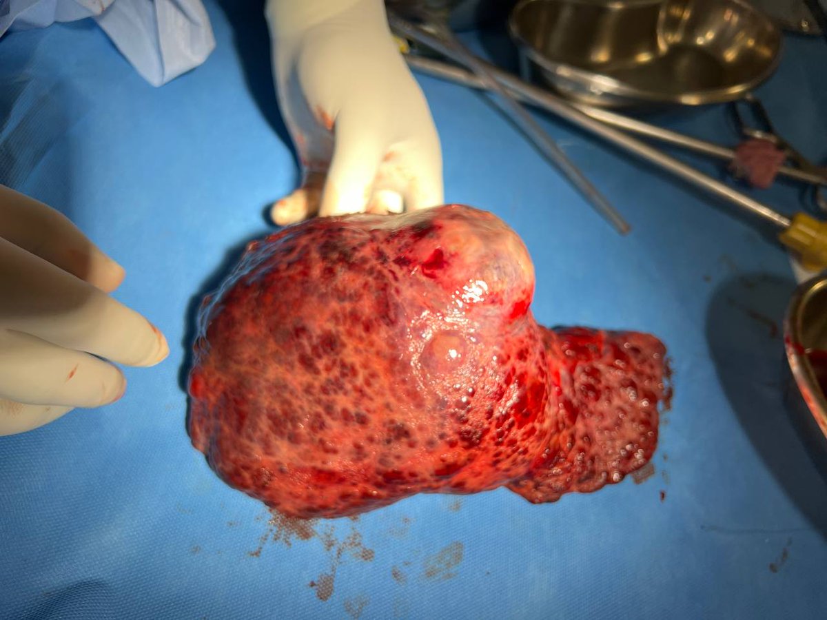 theliverdoc's tweet photo. Please do not forget everything that makes your liver look like this that you have the power to change:
1. Alcohol (this is your choice)
2. Hepatitis B virus (this is vaccine preventable)
3. Diabetes (this is treatable)
4. Overweight/ Obesity (this is reversible) 
5. High blood pressure/ Hypothyroidism (treatable)
6. Hepatitis C virus (treatable)
*[3, 4, 5 = metabolic syndrome]

Please do not forget everything that worsens it for your already weakened liver that you have the power to change:
1. Alcohol (this is your choice)
2. Tobacco (this is your choice)
3. Herbal drugs/ multiherbal health supplements
4. Dietary supplements including "medicinal herbs"
5. Sedentary activity (this is your choice)
6. Every single "detox" you see on the internet
7. Non-steroidal anti-inflammatory drugs (painkillers)
8. Alternative medicine practitioners (all of them, this is preventable)

Note: Paracetamol (also called acetaminophen) is the safest anti-fever and pain-management medicine even in cirrhosis (usually not more than 2-3g per day for 2-3 days)
