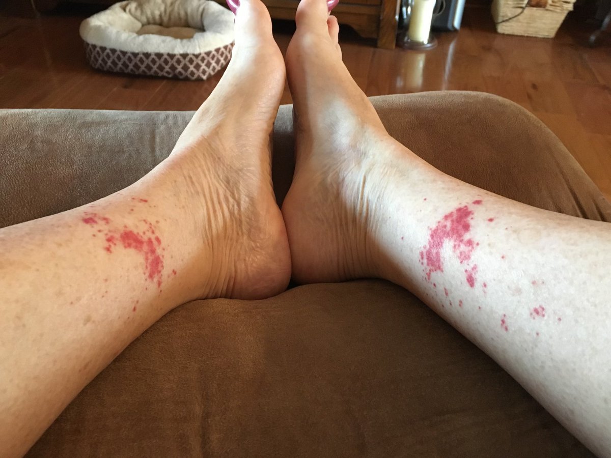 JakeSwenson7's tweet photo. For medical friends. Any idea what this could be? Bone marrow Bx soon. Not getting any answers as of now. https://t.co/3nZ9ouUolB