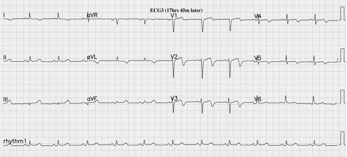 CP
Dx?
<a href="/MaruanCarlos/">Maruan C Chabbar</a> <a href="/yolyabreuh/">Yolanda Abreu H.</a> <a href="/UlhasDr/">Dr Ulhas Pandurangi</a> <a href="/DidlakeDW/">David Didlake</a> <a href="/ecgrhythms/">Arnel Carmona</a> <a href="/syamkumarmd/">Syamkumar</a> <a href="/IhabFathiSulima/">Dr Ihab Suliman</a> @DocNikko <a href="/DrPharmDMDTh/">TA✨</a> <a href="/Vadeboncoeur_Al/">Doc Vadeboncoeur</a> <a href="/EF_Cardiaca/">EfectoElectrotónico</a> <a href="/smithECGBlog/">Stephen W. Smith</a> <a href="/EM_RESUS/">Sam Ghali, M.D.</a> <a href="/iamritu/">Ritu Thamman MD</a> <a href="/paomorejon/">Paola Morejón Barragán</a> <a href="/KagawaECG/">KagawaECG</a> <a href="/estudiomedicina/">estudiomedicina</a> <a href="/OrlandoRPN/">Orlando RPN</a> <a href="/fxgodzeuss/">金子裕介 lucifer</a> #EPeeps #Cardioed #FOAMcc