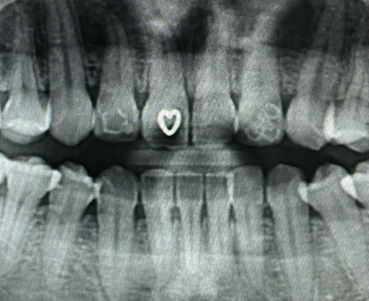 dokgodieinsaeng's tweet image. 행운의 치아 짤

주작 아니고 
어디 핀터레스트에 올라와있는
감성 짤 아니고 실제 제 치아임