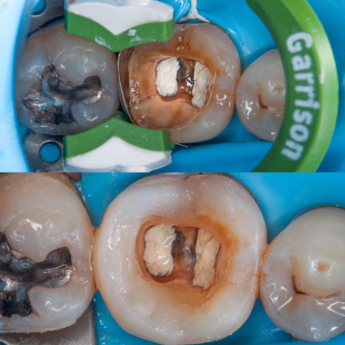 DrBaqerr's tweet photo. Retreatment case to prepare the tooth to receive ortho treatment 
Metal post removal + missing canal DL 
D canal was Vertucci classification type V
Cuspal reduction + building proixmal wall 
 Canlas was calcified,  Complete RE RCT + build up using ever x
تفاصيل الحالة تحت👇🏻 https://t.co/la8E6Uii6h