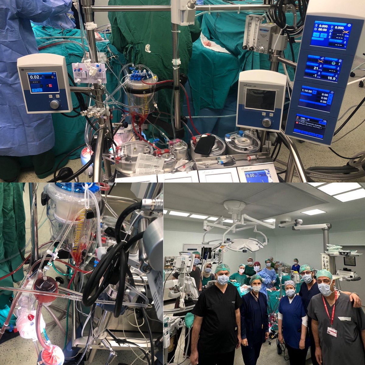 Zor hastalara devam : 80 y-Böbrek yetmezliği- Anemi-Ciddi kanama bozukluğu (trombosit: 95000) - ERAS ile hazırlık + Hasta kan yönetimi protokolü * Minidevre- Düşük doz heparinizasyon: Kapak+Koroner bypass- Kan nakli yok- 800 cc drenaj/24 s