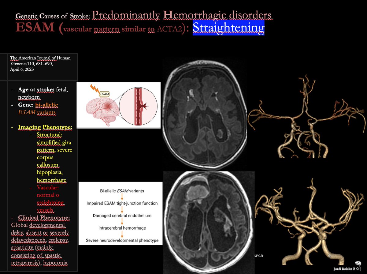 JordiRoldanB's tweet image. Straightening vessels of COW. Only in one of our patients. Similar to ACTA2. Included in your DDx.  Best key is hemorrhage.  #SPIN2023  Companion case  to those presented by
@ElaineYLKan