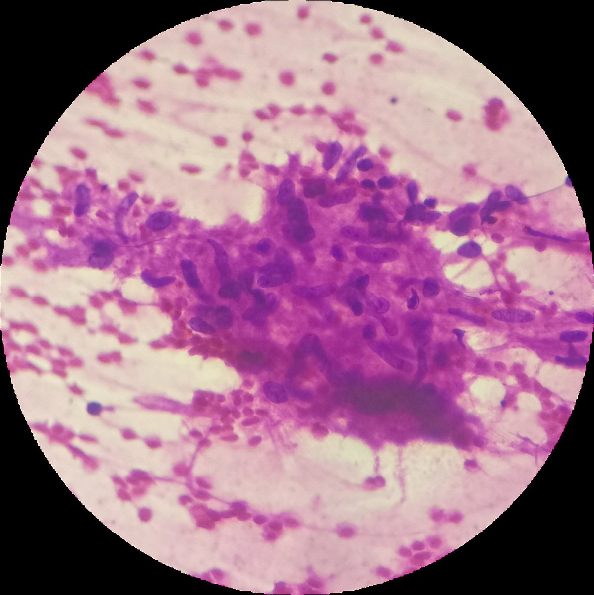 SyedSal55391459's tweet photo. #cytopathology
#lytic lesion of clavicle.
#FNAC (CT guided).
CT image and photomicrographs.
Dx: Granulomatous inflammation, suggestive of tuberculosis. https://t.co/CjE39CseRL