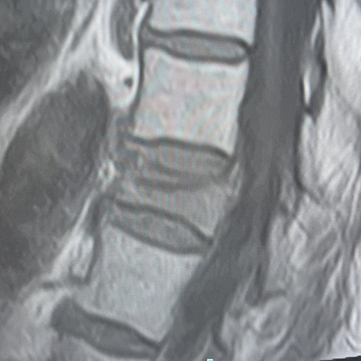 darthglader's tweet photo. More #MSKIR in a woman in her 90s who sat down hard in a chair and had sudden onset of back pain.
#MRI revealed #CompressionFracture of T11.
#Unipedicular #kyphoplasty.
🧵… https://t.co/Wg0xl7WowJ