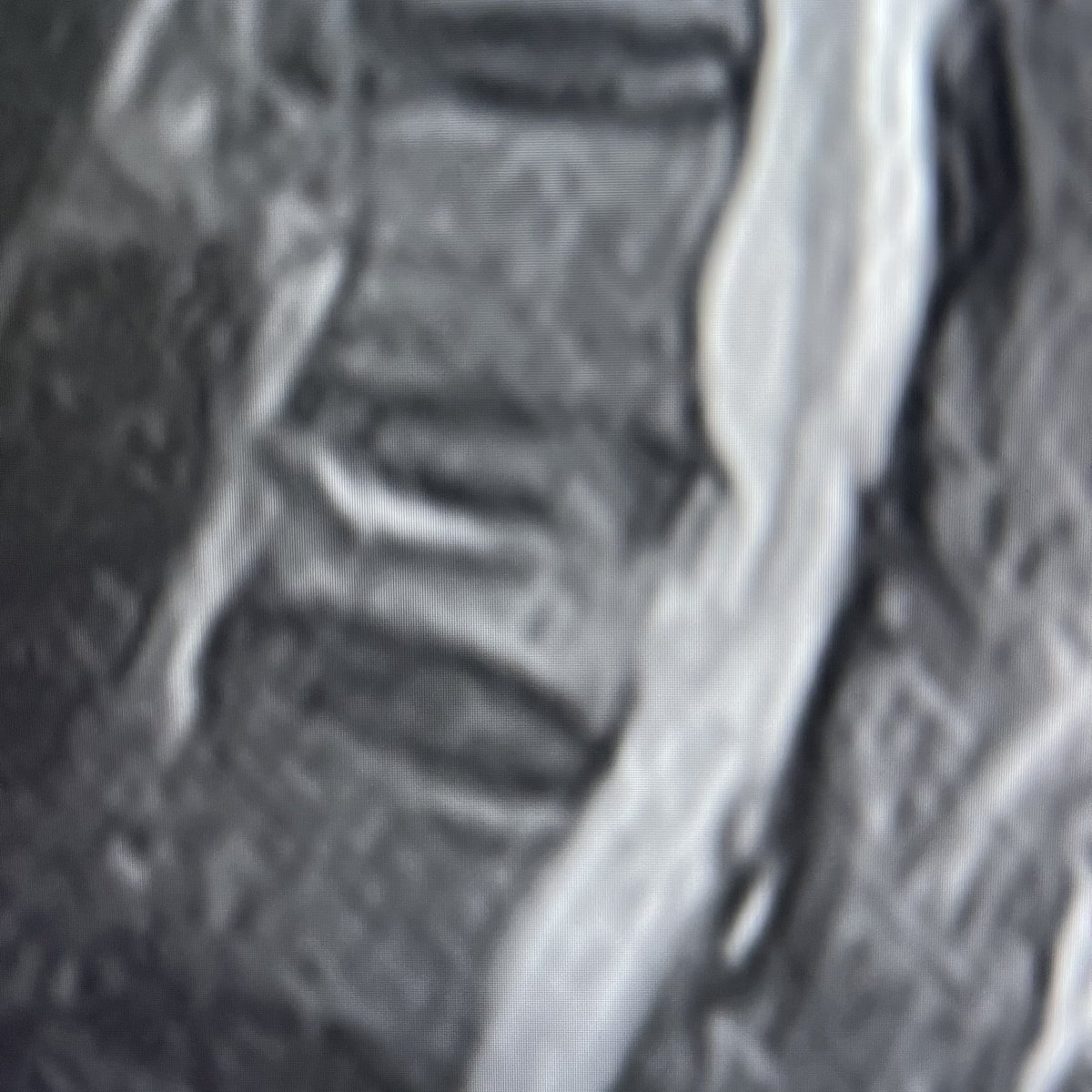 darthglader's tweet photo. More #MSKIR in a woman in her 90s who sat down hard in a chair and had sudden onset of back pain.
#MRI revealed #CompressionFracture of T11.
#Unipedicular #kyphoplasty.
🧵… https://t.co/Wg0xl7WowJ