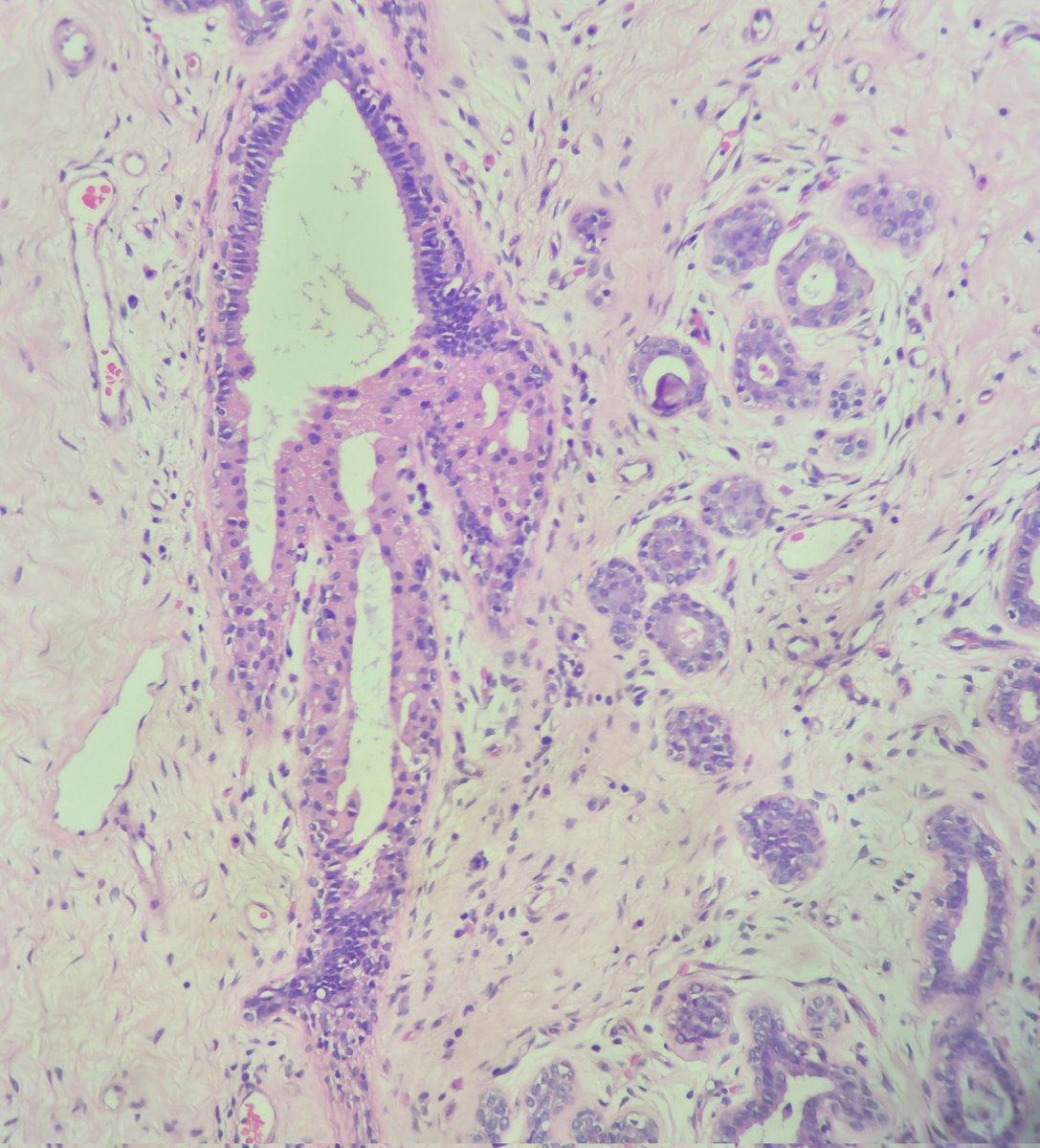 NevenaIlpath's tweet photo. Always very happy when I find transition from normal to metaplastic apocrine epithelium at one duct.
#breastpathology
#pathology 
#pathtweeter https://t.co/BLXil6ArEs