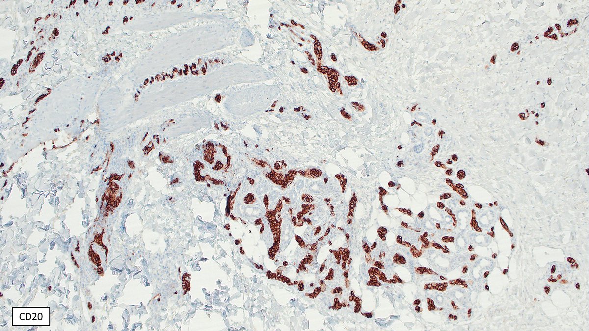 Illustration of a rare case of intravascular large B-cell lymphoma with "anaplastic features", this variant is previously described, the cells are more pleomorphic than the typical large immunoblastic presentation

#dermpath , these cases go to you first typically &amp; the