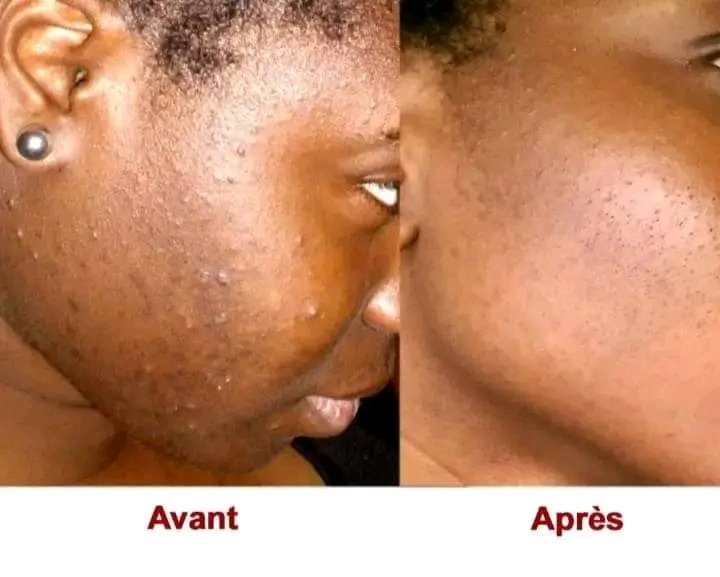 capilloux's tweet photo. Ki jan ou fè fas ak akne?

👇
  konsèy pou konbat akne 

 Kenbe po ou pwòp.

 Chwazi bon swen pou po a
Tankou savon ,seròm, losyon ak vitamin e .

 Rete deyò solèy la ak kabann bronzaj.po ou bezwen vitamin D .

Nou genyen pwodwi pou akne disponible 
Kontak :+50949017078
#haiti https://t.co/eNFPZH6teD