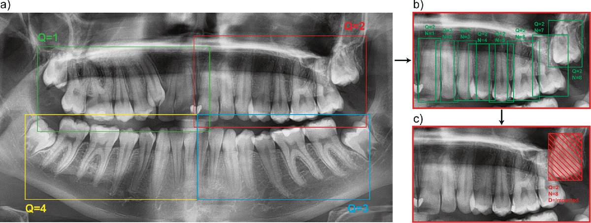 Recent publication using diffusion network for detecting objects in panoramic dental X-rays 🦷💪

Link to paper
DOI: doi.org/10.1007/978-3-…
SharedIt: rdcu.be/dnwJT

Link to the code repository
github.com/ibrahimethemha…

Link to the dataset(s)
github.com/ibrahimethemha…