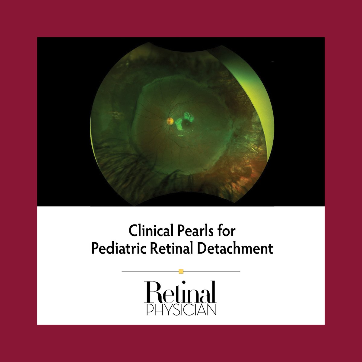 Drs. Ghalibafan, Cai, Berrocal, and Yannuzzi describe etiology, presentation, diagnosis, and management of pediatric retinal detachment: retinalphysician.com/issues/2023/no… #ophthalmology #retinaldetachment #pediatricretinaldetachment