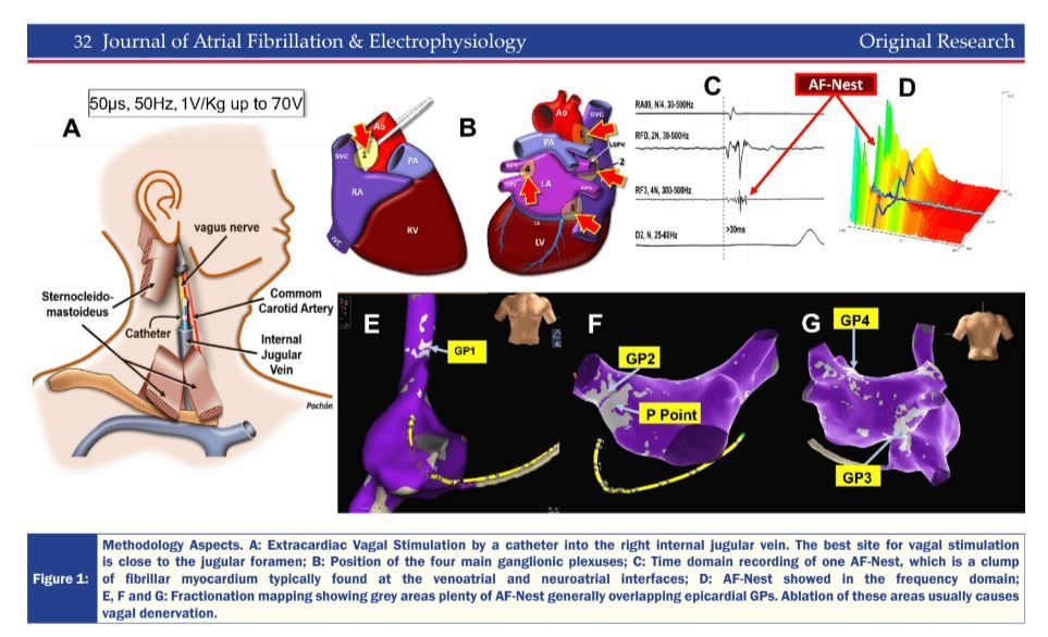 Impact of Cardioneuroablation with Vagal Denervation Confirmed by Vagus Nerve Stimulation on Pulmonary Vein Isolation for Atrial Fibrillation Catheter Ablation buff.ly/40FFVCY