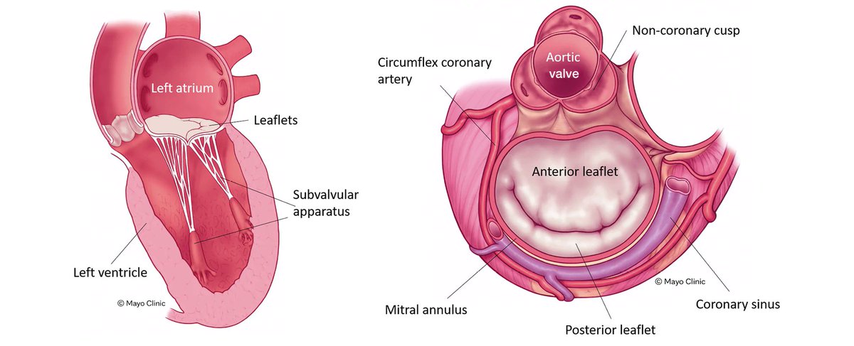 2023 State-of-the-art review on transcatheter mitral valve replacement (TMVR) for the treatment of native mitral valve disease, from indication to results. @EuroInterventio @PCRonline
eurointervention.pcronline.com/article/transc…
#Cardioed #cardioTwitter #cardiology