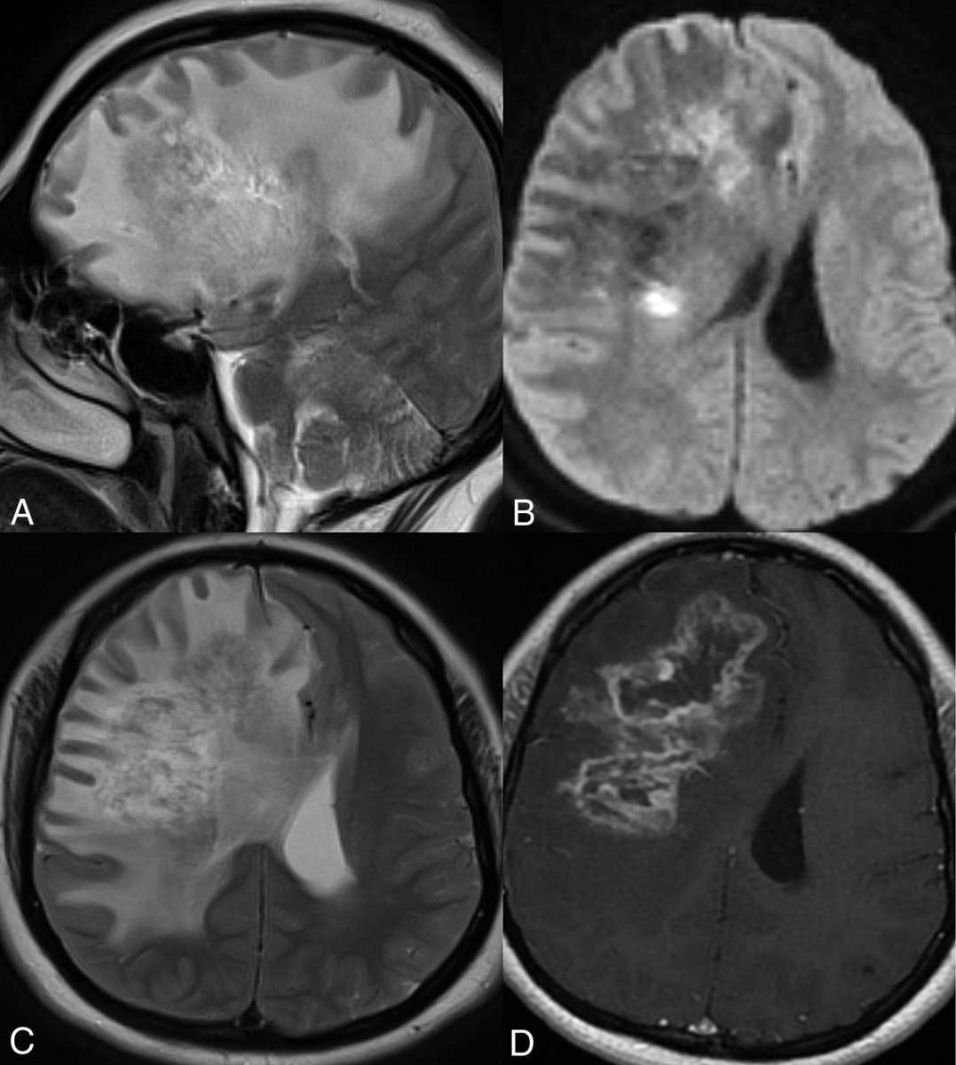 Newly Recognized Genetic Tumor Syndromes of the CNS in the 5th WHO Classification: Imaging Overview with Genetic Updates @TheAJNR @theAJNR_EIC ajnr.org/content/early/… Cerebroretinal vasculopathy and leukoencephalopathy in a 20-year-old man with FA. MR imaging including a…