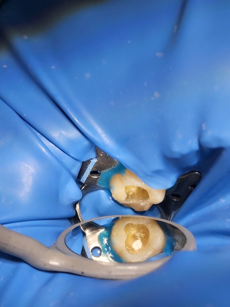 دائما كن متحفظاً 💙

Direct pulp capping case using MTA.