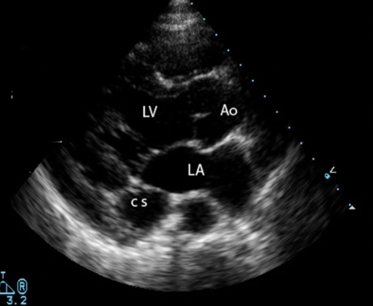 Umair2017's tweet photo. 4/4
📌On #EchoFirst if you ever see a dilated CS, you must consider dx of #PLSVC
📌Dx: inject agitated saline via LUE IV to see it in CS
📌However, if the LA also fills up, it may suggest an additional unroofed CS (rarest form of ASD), which is associated with PLSVC 🤝 https://t.co/h2gJJL0OLE
