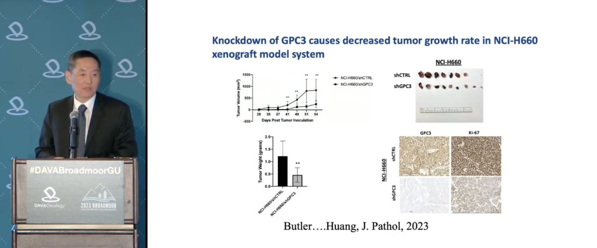 Dr. Jiaoti Huang presents preclinical data for Glypican-3 (GPC3), an oncofetal protein expressed on NE cells in CRPC. This is an exciting new target with minimal off-tumor effects due to the oncofetal nature of the protein!

…thsocjournals.onlinelibrary.wiley.com/doi/10.1002/pa…

#DAVABroadmoorGU