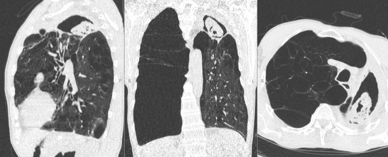 Saturday night case! 🥴 🚹70 yo with severe emphysema but no other clinical info available. I'm thinking subacute invasive Aspergillosis as the first differential. Would you consider Aspergilloma to? (no priors). Other ideas? Thanks @damiwainstein for sharing! #radiology