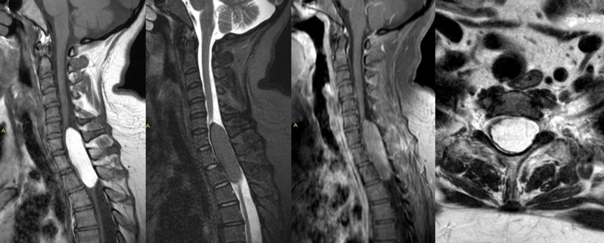 josealejandrobv's tweet image. 31 yo female with long-standing quadriparesis . Intramedullary ovoid lesion with intrinsic high T1 signal that suppresses on STIR. No CE. Dark T2 rim, most like calcification. Findings support  spinal cord lipoma #neurorad #spinerad @TheAJNR @The_ASSR