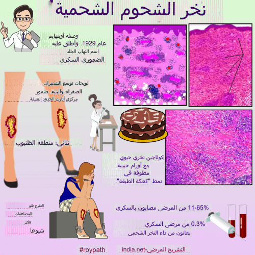 IhabFathiSulima's tweet photo. نخر الشحوم الشحمية
وصفه أوبنهايم
عام 1929. وأطلق عليه
اسم التهاب الجلد
الضموري السكري
لويحات توسع الشعيرات
الصفراء والبنية. ضمور
مركزي أثارت الحدود العنيفة
ثنائي؛ منطقة الظنبوب
كولاجين نخري حيوي
مع أورام حبيبية
مطوقة في
نمط "كعكة الطبقة".
التقرح هو
المضاعفات
الأكثر
شيوعا
#roypath
11-65% من المرضى مصابون بالسكري
0.3% من مرضى السكري
يعانون من داء النخر الشحمي
التشريح المرضي-india.net