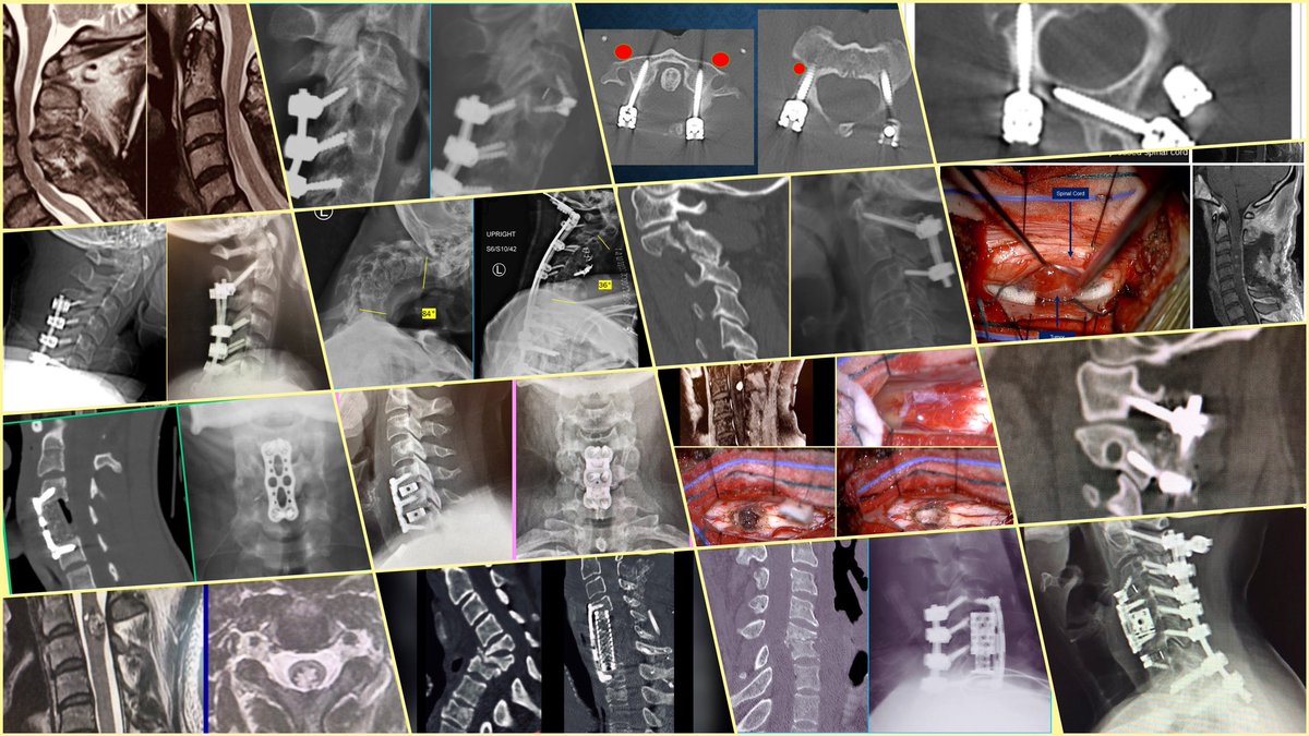 On a more serious note, the cervical spine is simply amazing! #neurosurgery