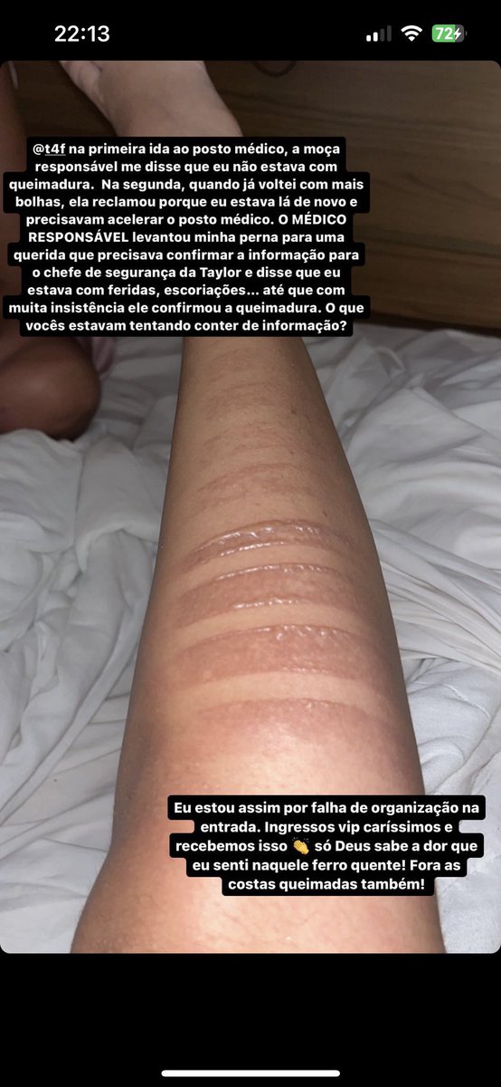 choquei's tweet photo. 🚨ATENÇÃO: Fãs de Taylor Swift que estiveram ontem (18) no estádio Nilton Santos sofreram queimaduras de segundo grau na perna após caírem em placas de metal que estavam no chão na pista do evento. https://t.co/1AYpjcoK1g