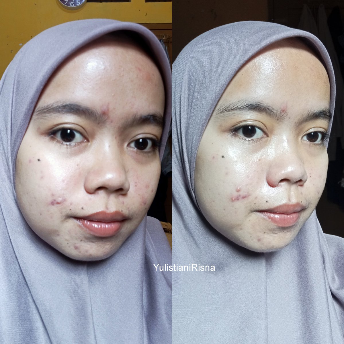 risnay19_'s tweet photo. Jerawatku mendingan banget pake rangkaian skincare dari @Adara_ID ♡.
Emang paling bener acne prone pakenya yang basic-basic aja, kalo istilah jaman sekarang mah SKINCARE MINIMALISM.
#PMSnoWorries #ProtectMySkin #racuninskincare https://t.co/IeiQOn7OIO