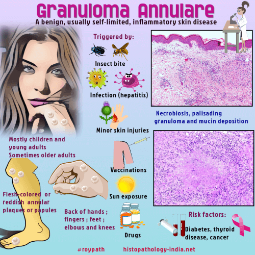 schowardjd's tweet photo. @docxusofficial 🎶 "Dude looks like a lady" 🎵

That's granuloma annulare. 

Triggered by insect bites, sun exposure, viral infections, DM, thyroiditis, Ig-mediated vasculitis, antibiotics, anti-inflammatories, &amp; oral contraceptives.

[img source: @DrSampyRoy, #RoyPath, https://t.co/3p07kFMD8l] https://t.co/WSQKUwiPlH