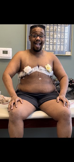 I am officially PostOp!  Boobies are gone forever!  #topsurgery #ftm #TransAwarenessWeek #transman #transjoy<a href="/tag/ftm"class="tags"><span>#ftm</span></a><a href="/tag/transawarenessweek"class="tags"><span>#transawarenessweek</span></a><a href="/tag/transman"class="tags"><span>#transman</span></a><a href="/tag/topsurgery"class="tags"><span>#topsurgery</span></a>
