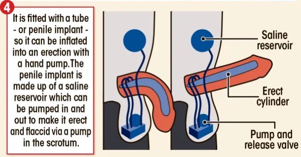 Penis construction #MedEd