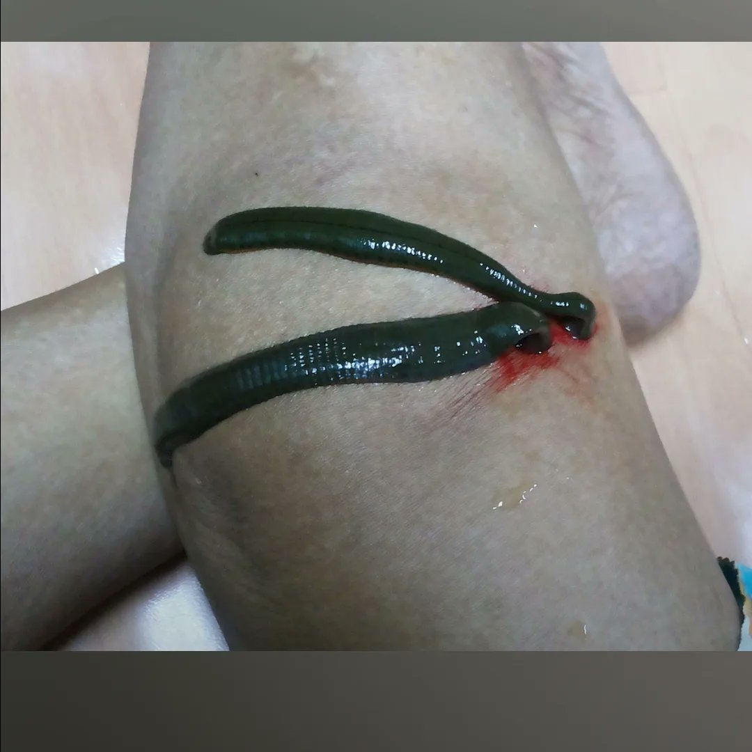 Unlocking Nature's Healing: Leech Therapy for Knee Pain Relief 🩹🌿 #LeechTherapy #AyurvedaHealing #NaturalJointCare
Dr. Satish Suryawanshi, Ayurvedacharya, specializes in holistic Ayurvedic treatments4 knee joint pain. Leech therapy, an ancient practice, offers remarkable relief