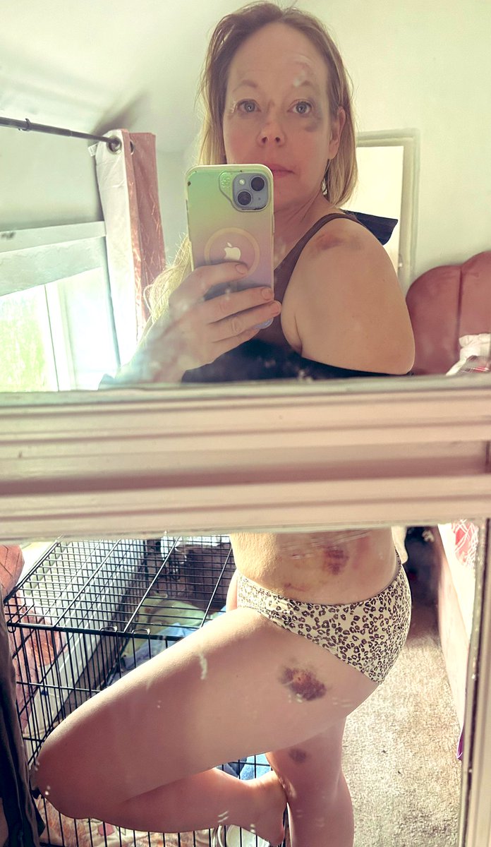 saxelbyhorses's tweet photo. Not my best side at the moment 🙃

This is the result of a cycling accident (no cars involved) a few days ago! 

#cycling https://t.co/LQspRY1U38