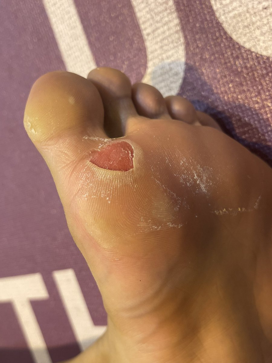 Angelo_Mikha's tweet photo. Warning : graphic photo.

Telapak kiri @geugouia kemarin, telapak kanan tadi.

Masih ga ngerti gimana bisa fight segitu kerennya, padahal jalan aja perih😵

 🥇 https://t.co/O7lUhuQNXg